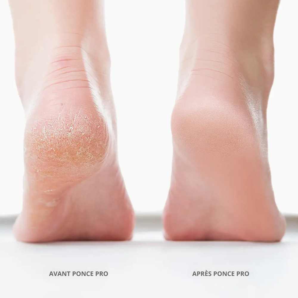 Ponce Pro - Fini les pieds rêches