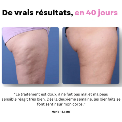 Ventooz -Ventouse Anti-cellulite
